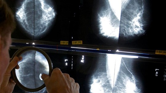 Cancer du sein: dépistage gratuit désormais élargi aux Québécoise de 70 à 74 ans