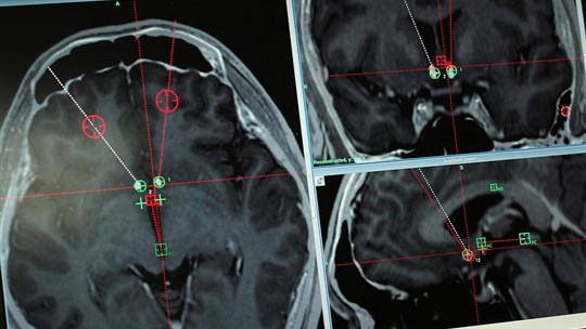 Nouvelle étude sur la santé cognitive des aînés