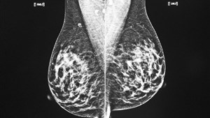 Une étude détaille l'association entre l'obésité et le cancer du sein
